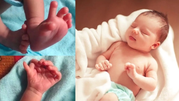 Baby born with 25 figures