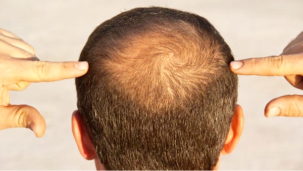 Suicide due to hair loss