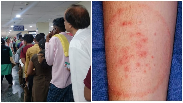 Health department alert due to increase in fungal infection dengue and malaria patients in rains