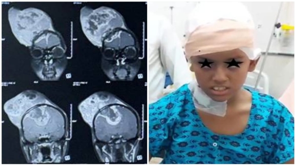 Brain tumor from head successfully removed in AIIMS Bhopal
