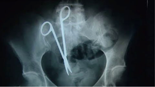 Doctor left scissors in stomach Mandsaur