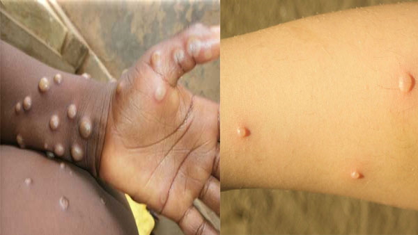 manki pox