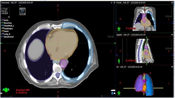 AI technology of AIIMS and IISER Bhopal will revolutionize cancer detection