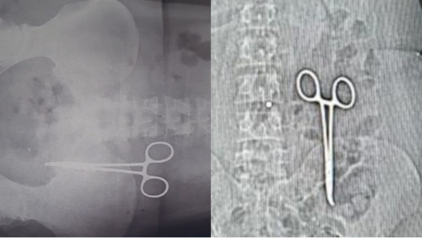 Bhind doctor left scissors in woman s stomach
