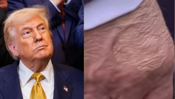 Pi7 Tool donald-trump with chronic venous