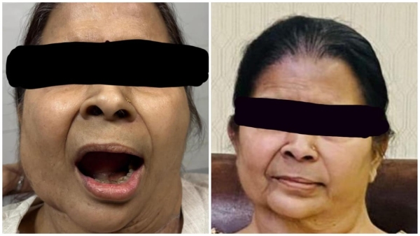 Central India first artificial jaw implant surgery in AIIMS Bhopal woman gets a new life