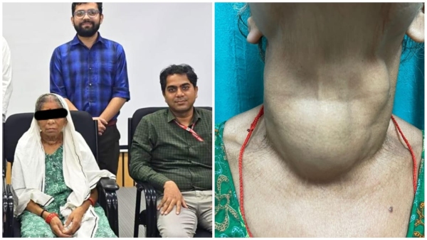 AIIMS Bhopal Successful operation of 65-year-old woman suffering from huge goiter