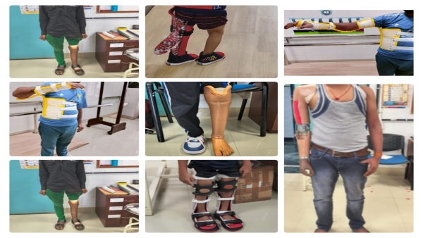 Prosthetic service of AIIMS Bhopal is giving the power of self-reliance to the disabled people Prosthetic service of AIIMS Bhopal is giving the power of self-reliance to the disabled people