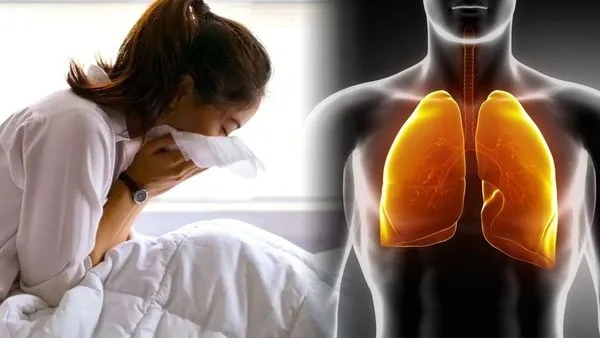 Tuberculosis