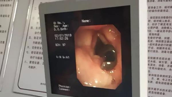 WATCH: 3-cm long live blood-sucking leech removed from woman’s throat