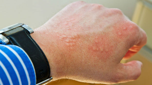 From COVID Toes to Hives: 5 signs on your skin that could mean you have Coronavirus