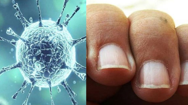 Are COVID nails a sign that you had coronavirus?: Check out for these changes to your fingernails Are COVID nails a sign that you had coronavirus?: Check out for these changes to your fingernails