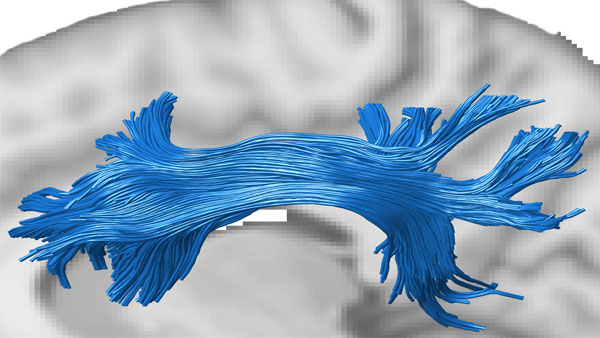 The image shows the superior longitudinal fasciculus (SLF), a white matter tract that connects the prefrontal and parietal cortex, two attention-related brain regions. The tract was estimated with diffusion MRI and tractography in the living human brain (Credits: Varsha Sreenivasan and Devarajan Sridharan)