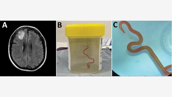 First-Of-Its-Kind: 8 cm Live Worm Found In 64-Year-Old Australian Womans Brain First-Of-Its-Kind: 8 cm Live Worm Found In 64-Year-Old Australian Womans Brain
