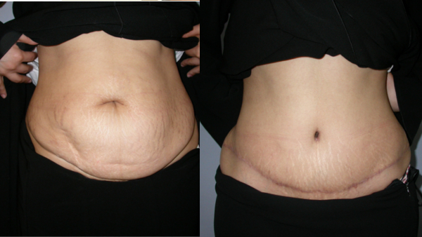 “ Tummy tuck surgery, has a Vital importance in today’s Dynamic & Busy Lifestyle” Dr James Roy Kanjoor