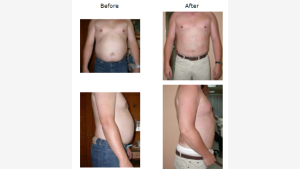 “ Tummy tuck surgery, has a Vital importance in today’s Dynamic & Busy Lifestyle” Dr James Roy Kanjoor