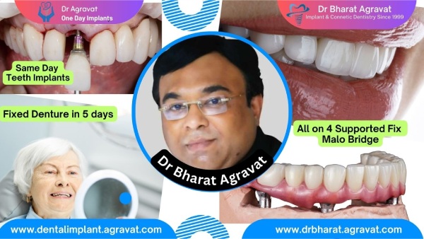 Regain Your Smile with Dr Bharat Agravat s Full Mouth Dental Implants in Ahmedabad