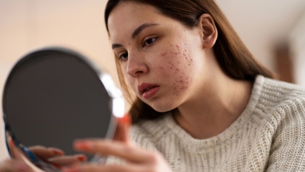 How To Manage Acne And Maintain A Healthy Glow 10 Best Skincare Tips To Manage This Condition Better