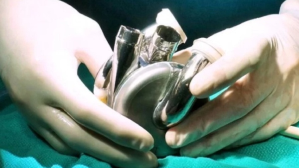 Titanium Heart Implant Milestone In Medical Science
