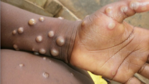 Rising Mpox Cases In African Countries Rising Mpox Cases In African Countries