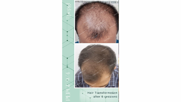 Boost Hair Health Foods for Hair Growth and Skin Care