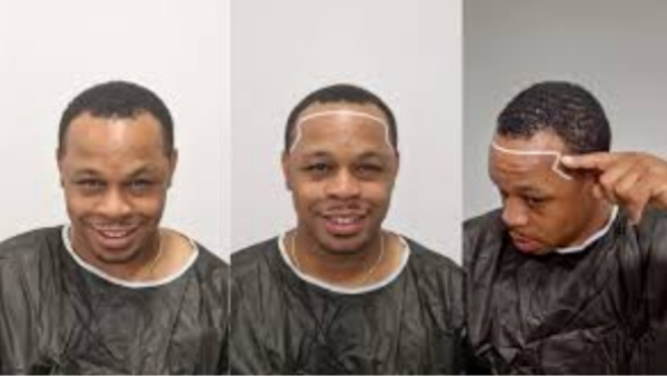 What are the Best Hair Transplant Clinics in Turkey and What Are Their Prices