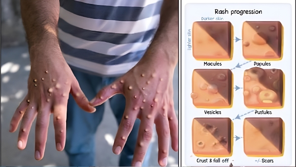 Monkey Pox What Is There To Know