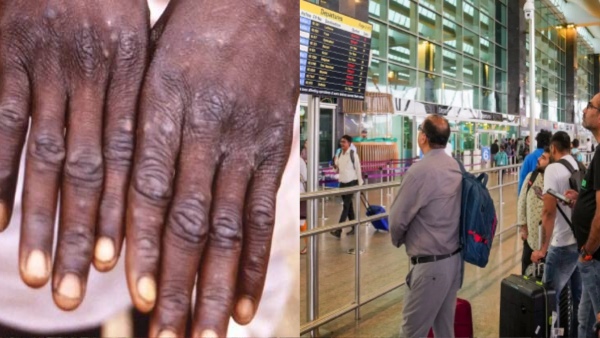 Mpox Threat Bengaluru Airport
