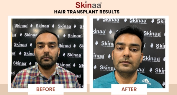 From London to India My Life-Changing Hair Transplant Journey at Skinaa Clinic Jaipur