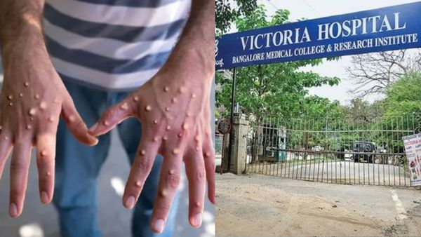 Monkeypox Case