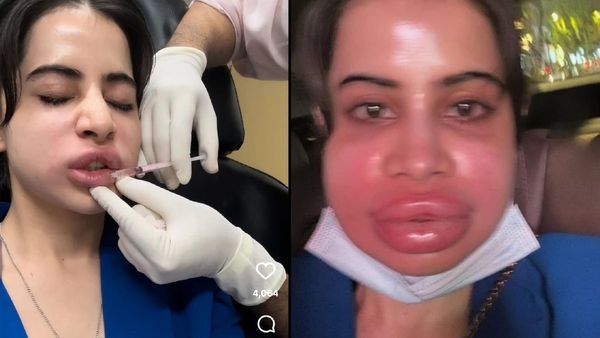 Urfi Javed Undergoes Lip Filler Dissolving Procedure, Reveals Swollen Face Online - Oneindia News