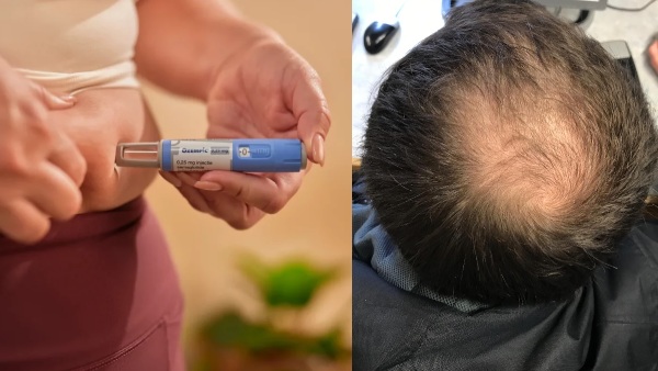 What is Ozempic Hair What is Ozempic Hair
