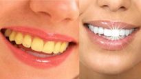 Teeth Tips: ಪ್ರತಿದಿನ ಹಲ್ಲುಜ್ಜಿದರೂ ಹಲ್ಲುಗಳು ಹಳದಿಯೇ? ನಗು ಮಾಸದಿರಲು ದಂತ ವೈದ್ಯರ ಸಲಹೆ ಪಾಲಿಸಿ