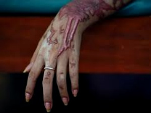 acid attack acid attack