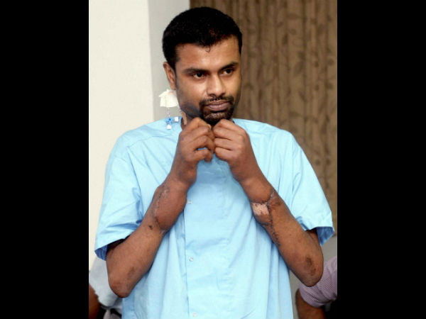 ಭಾರತದ ಪ್ರಥಮ ಕೈ ಕಸಿ