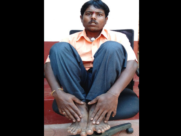 Is Gadag person born with six fingures in both hands and leg