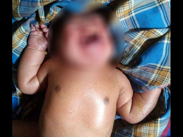 Mother dies after giving birth to child with deformity