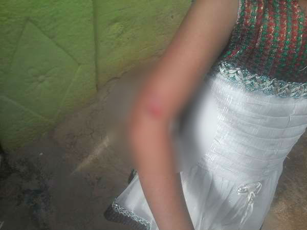 Dog attacked G P president daughter, Mysuru