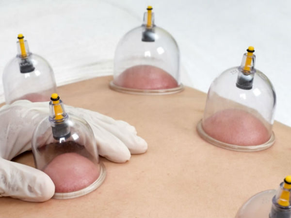 Hijama therapy in Venlakh hospital Mangalore