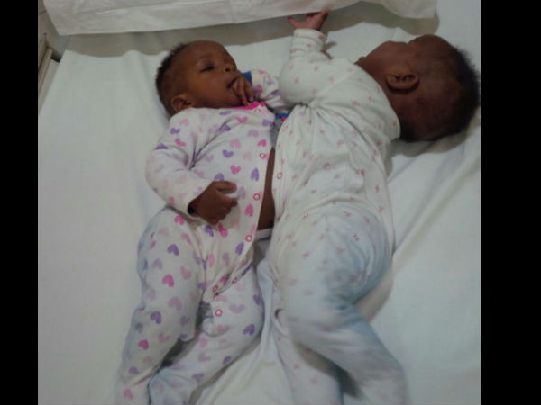 Conjoined twins from Nigeria successfully separated at Narayana Health City Conjoined twins from Nigeria successfully separated at Narayana Health City