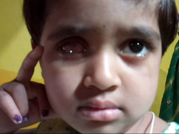 Girl lost vision by consuming medicines of fake doctor in Chamarajanagara 