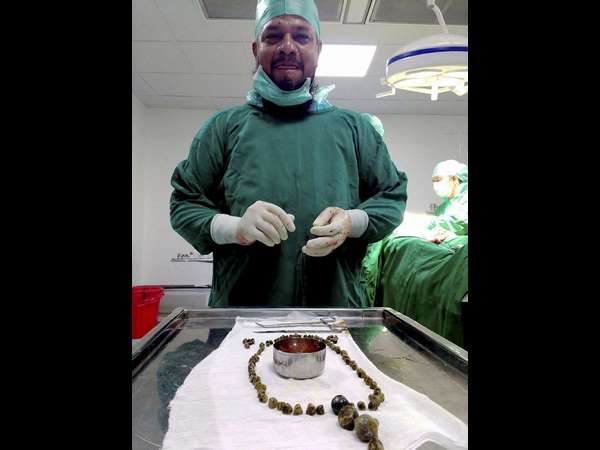  ಮಹಿಳೆಯ ಮೂತ್ರಕೋಶದಲ್ಲಿ 99 ಕಲ್ಲುಗಳು