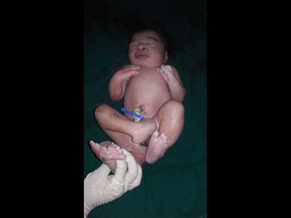 Miracle Baby born with 3 legs in Ballari, Karnataka 