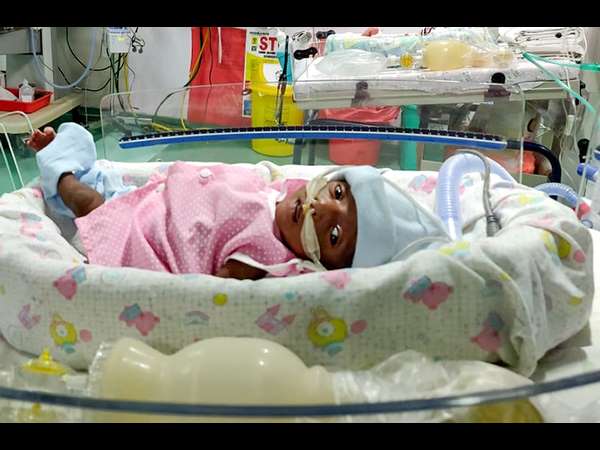 30 days girl child born prematurely and on ventilator