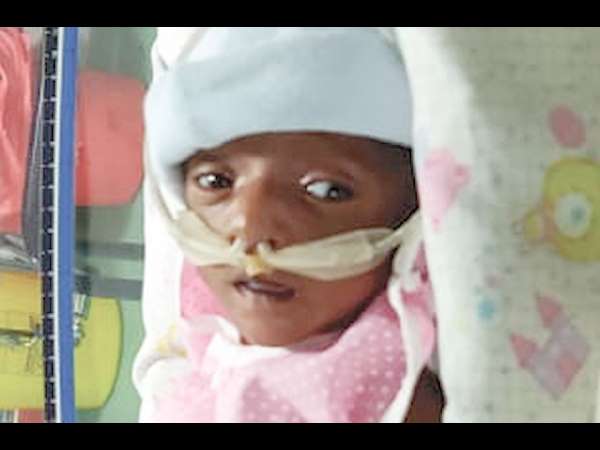 30 days girl child born prematurely and on ventilator
