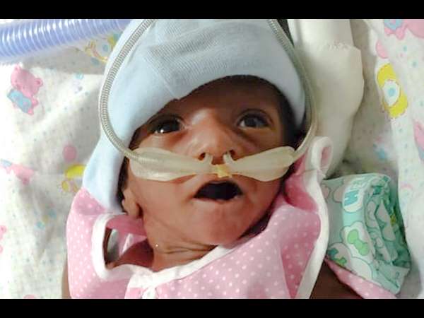 30 days girl child born prematurely and on ventilator