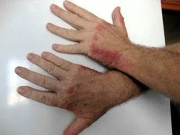 ರೋಗದ ಲಕ್ಷಣಗಳೇನು?