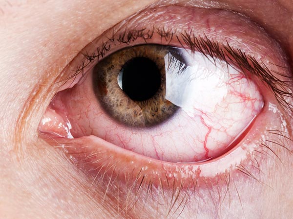 ಐ ಡ್ರಾಪ್ ಮಾರಾಟ ಹೆಚ್ಚಳ