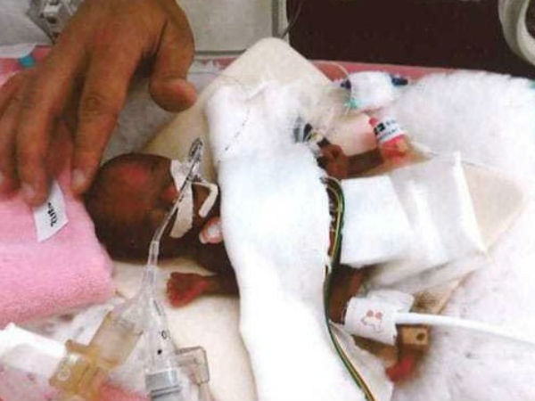 This is worlds smallest baby boy, Weighing 258 grams 
