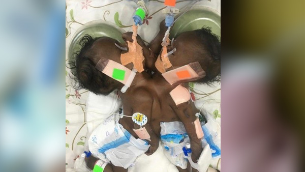 ಮಕ್ಕಳು ಪರಸ್ಪರ ಹಂಚಿಕೊಂಡ ಹೃದಯವನ್ನು ಹೊಂದಿದ್ದು